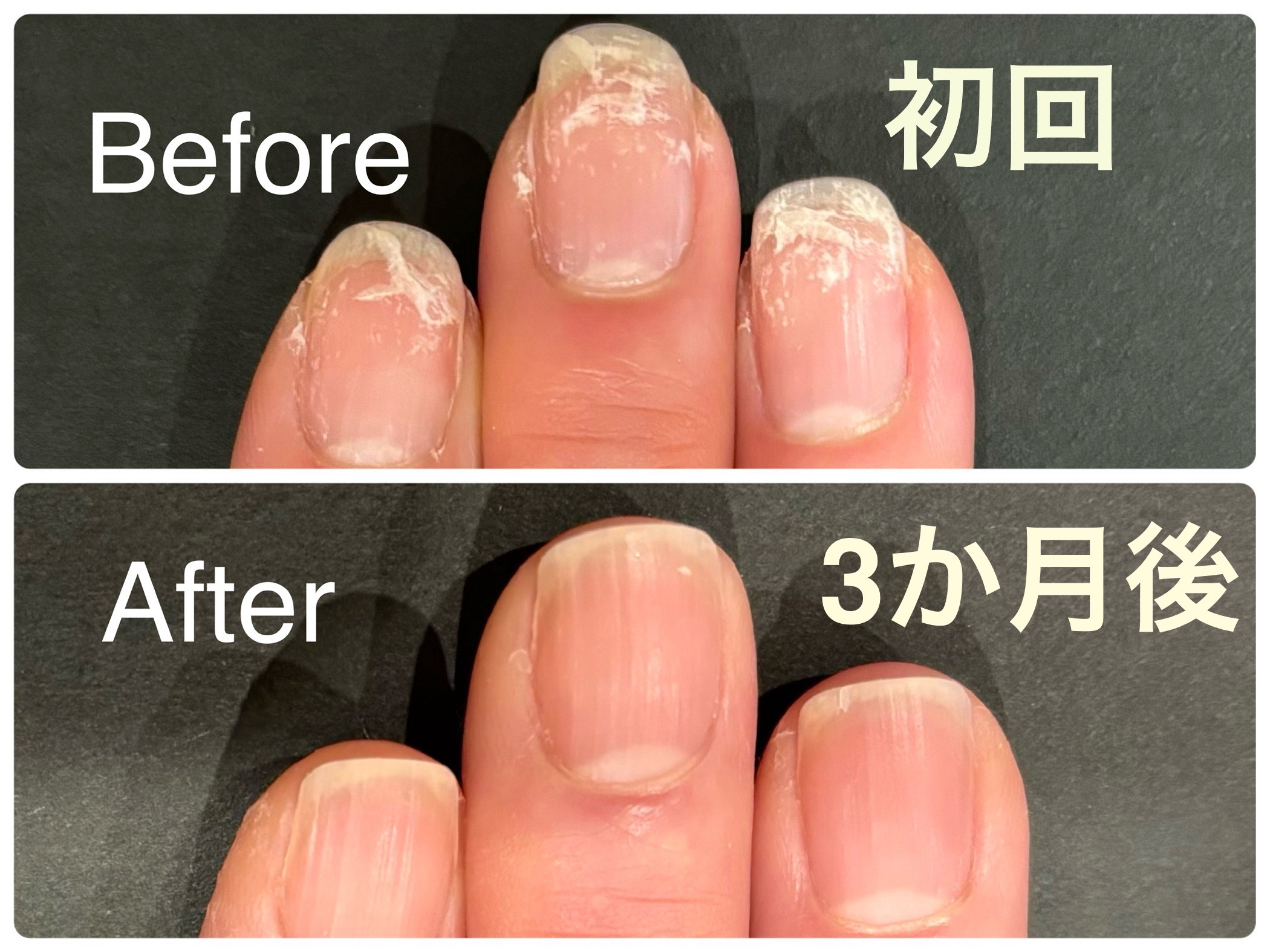 ジェルネイルを止めた後の爪に悩んでいました